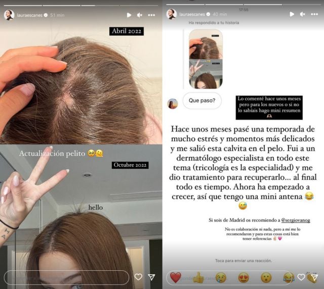 Laura Escanes muestra el antes y el después de su problema de pelo