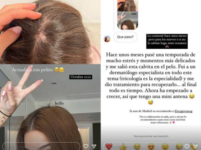 Laura Escanes muestra el antes y el después de su problema de pelo