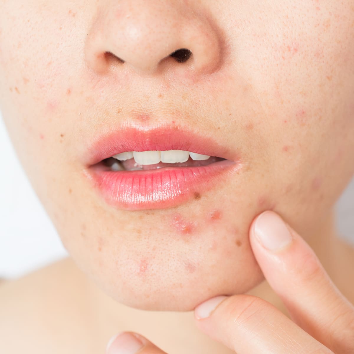 Adiós a los granos en verano: 7 trucos de belleza para hacer que desaparezcan, según dermatólogos
