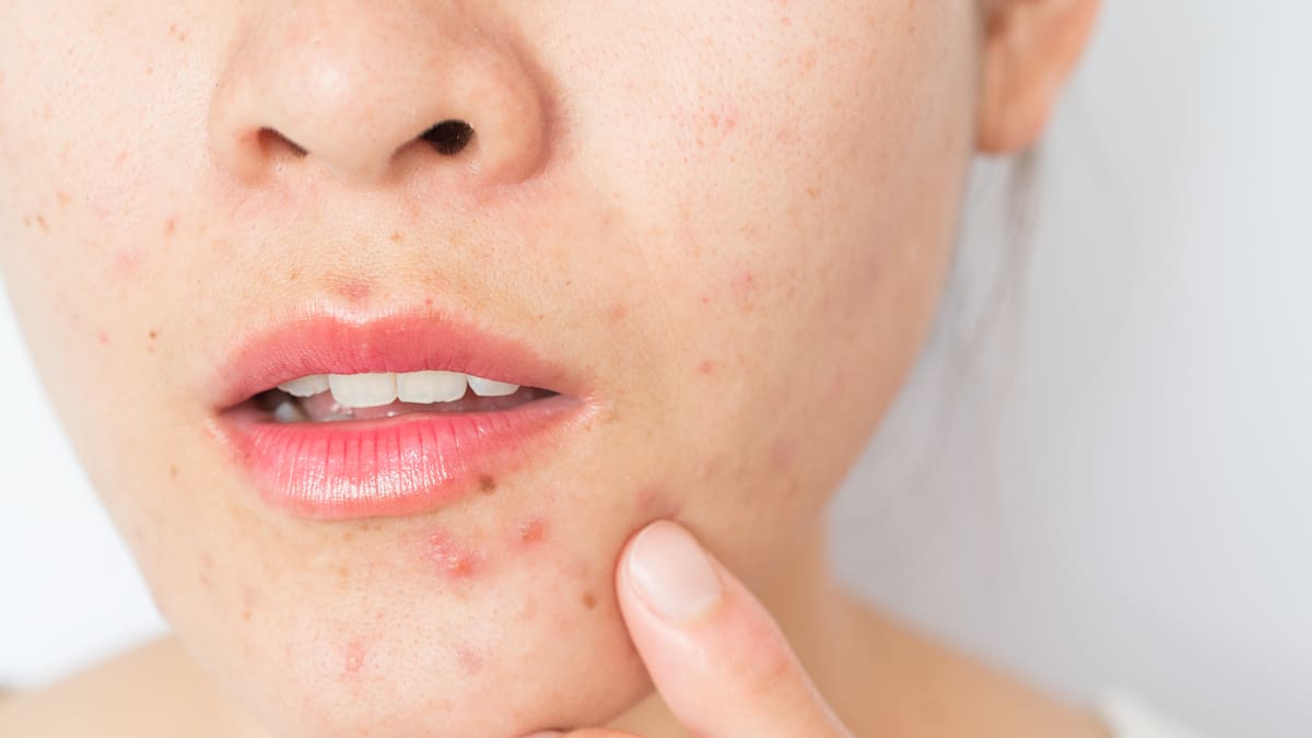 Adiós a los granos en verano: 7 trucos de belleza para hacer que desaparezcan, según dermatólogos