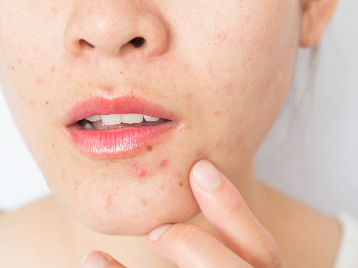 Adiós a los granos en verano: 7 trucos de belleza para hacer que desaparezcan, según dermatólogos