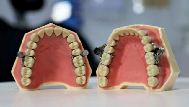 Los dientes primero se separan para introducir un aparato magnético que mantiene la boca cerrada