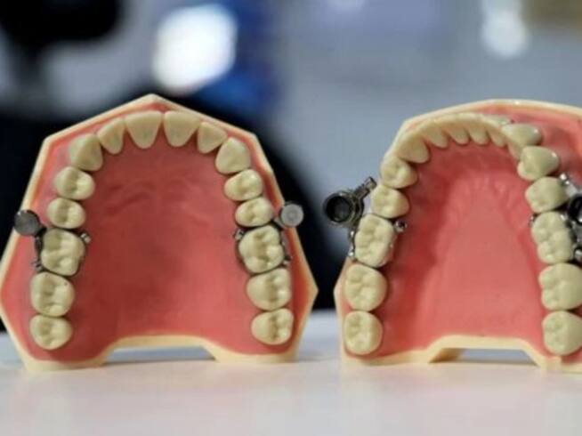 Los dientes primero se separan para introducir un aparato magnético que mantiene la boca cerrada