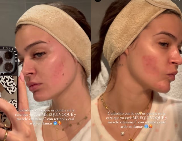 Laura Escanes muestra lo que le ha ocurrido al juntar Vitamina C con retinol