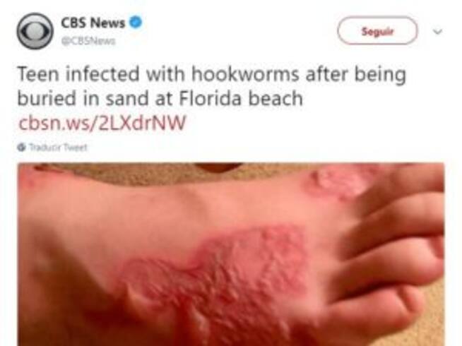 Se infecta en la playa