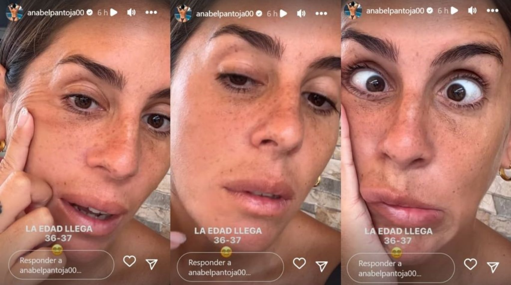 Anabel Pantoja muestra el estado de su piel sin filtros.