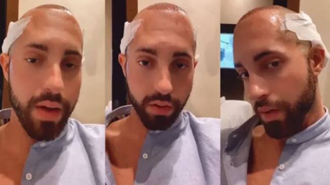 Imágenes de Pablo tras su trasplante capilar.