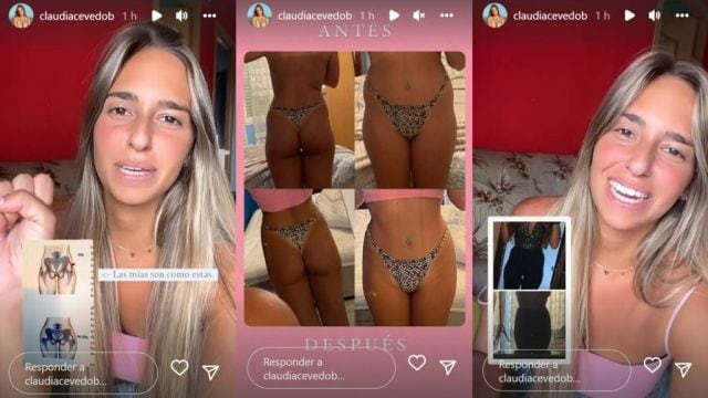 Claudia Acevedo muestra el antes y después de su primer retoque estético.