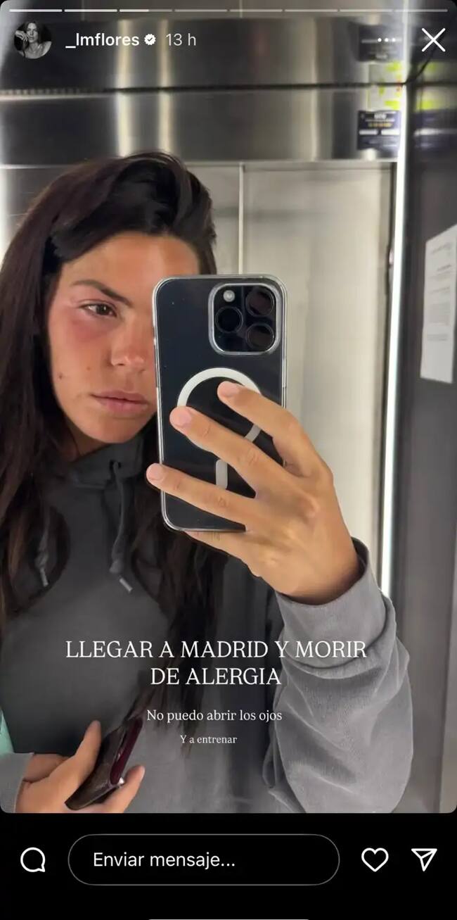 Laura Matamoros con alergia en su Instagram