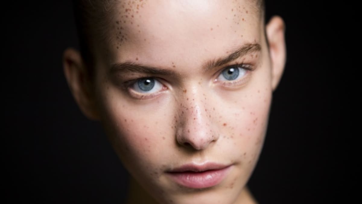 ¿Estarían dispuestos a hacer el "Freckling"?
