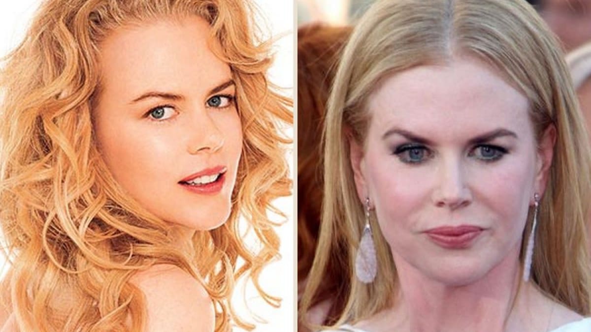 A estas celebrities la cirugía estética no les sentó bien